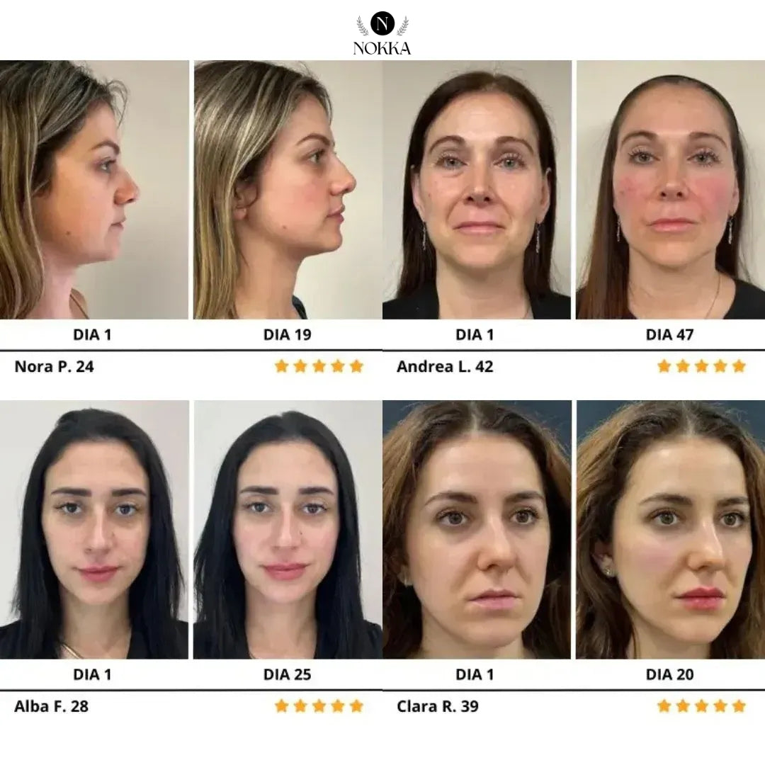 ElevaSkin™ – Efecto Lifting con Tecnología LED
